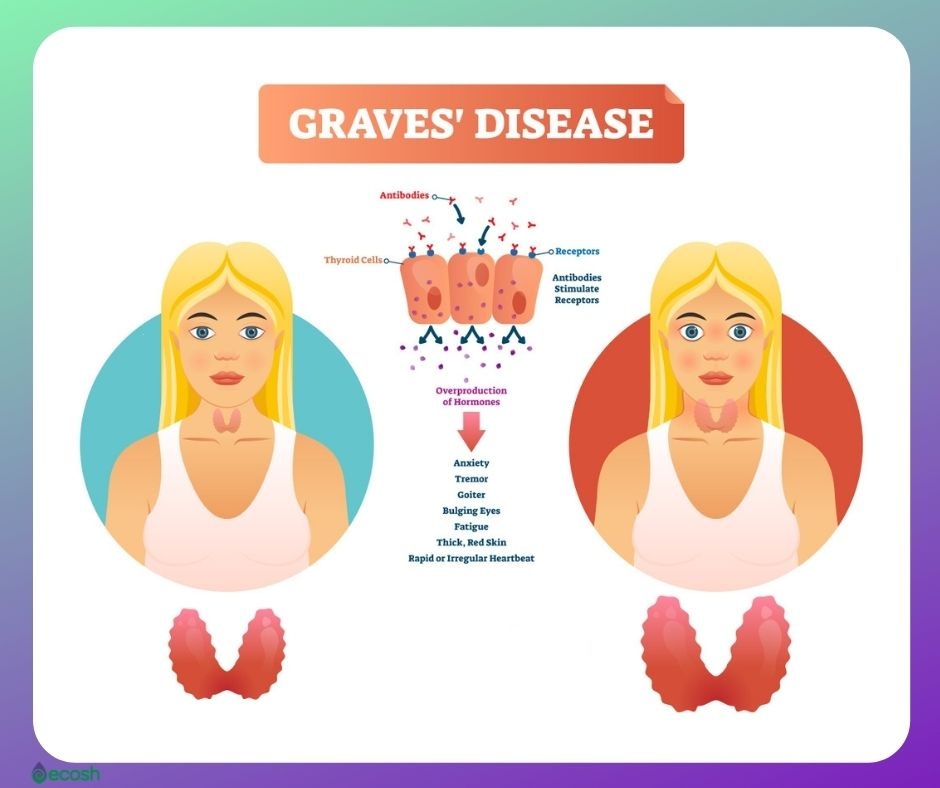 Graves Disease